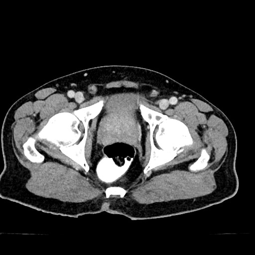 Acute appendicitis (Radiopaedia 77016-88960 Axial C+ portal venous phase 137).jpg