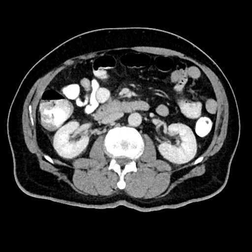 File:Acute appendicitis (Radiopaedia 77016-88960 Axial C+ portal venous phase 64).jpg
