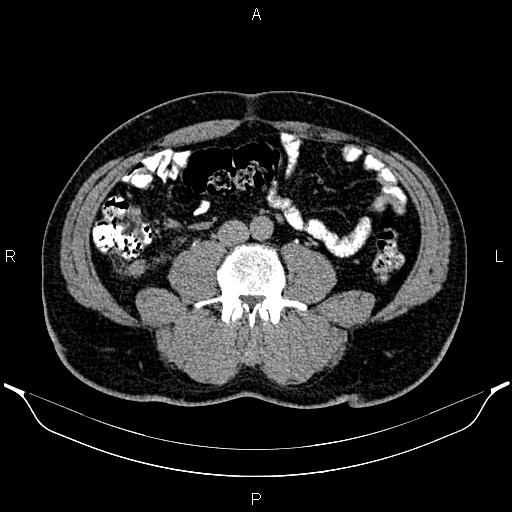 File:Acute appendicitis (Radiopaedia 84780-100240 Axial C+ delayed 61).jpg