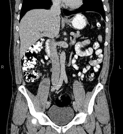 Acute appendicitis (Radiopaedia 84780-100240 Coronal C+ portal venous phase 39).jpg