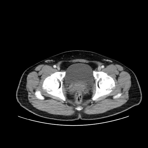 File:Acute appendicitis and COVID 19 pneumonia (Radiopaedia 76604-88380 Axial C+ portal venous phase 81).jpg