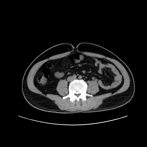 Acute appendicitis and COVID 19 pneumonia (Radiopaedia 76604-88380 Axial non-contrast 85).jpg