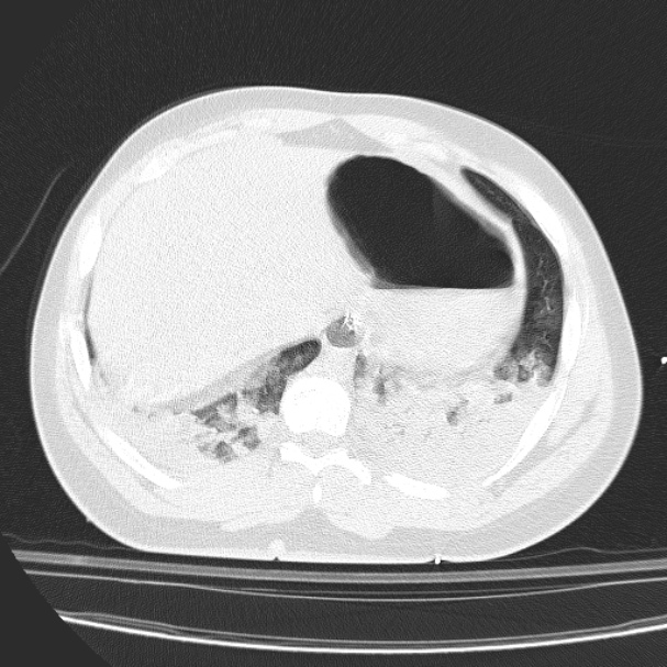 Acute aspiration pneumonitis (Radiopaedia 33605-34703 Axial lung window 81).jpg