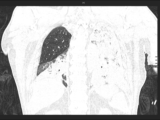 Acute aspiration pneumonitis (Radiopaedia 55642-62166 Coronal lung window 77).jpg