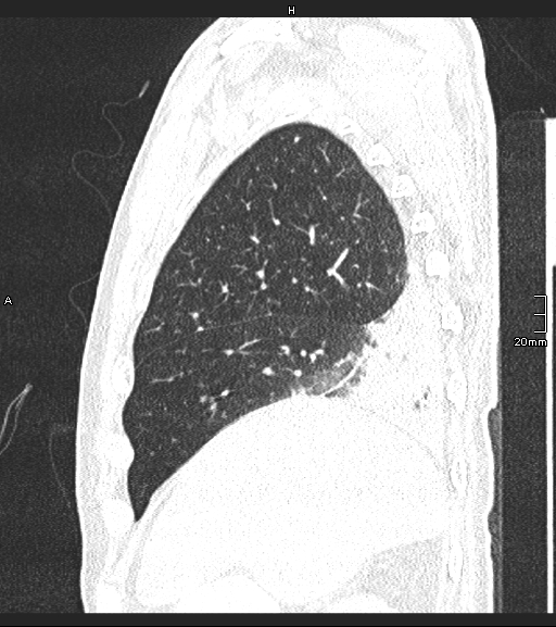 File:Acute aspiration pneumonitis (Radiopaedia 55642-62166 Sagittal lung window 122).jpg