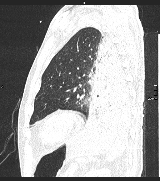 File:Acute aspiration pneumonitis (Radiopaedia 55642-62166 Sagittal lung window 32).jpg