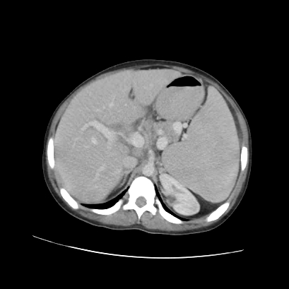 Acute calculous cholecystitis in patient with osteopetrosis (Radiopaedia 77871-90159 Axial C+ portal venous phase 29).jpg