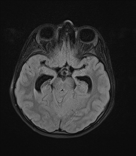 File:Acute cerebellar ataxia (Radiopaedia 61487-69446 Axial FLAIR 8).jpg