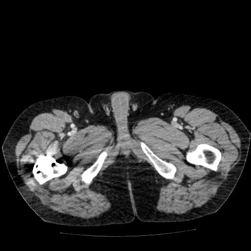 Acute cholecystitis and incidental left sided IVC (Radiopaedia 49352-54459 Axial C+ portal venous phase 172).jpg
