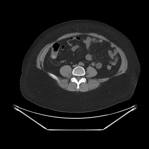 Acute cholecystitis with tensile fundus sign (Radiopaedia 71394-81723 Axial non-contrast 67).jpg