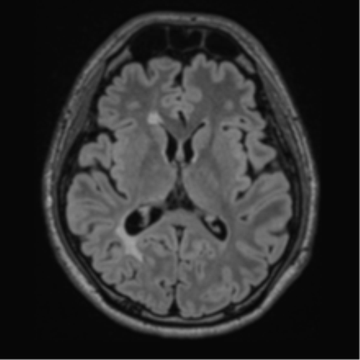 Acute disseminated encephalomyelitis (ADEM)- Anti-NMDA receptor encephalitis (Radiopaedia 54920-61201 Axial FLAIR 36).png