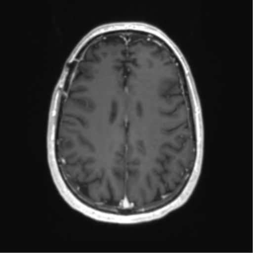 Acute disseminated encephalomyelitis (ADEM) (Radiopaedia 65319-74350 Axial T1 C+ 44).png