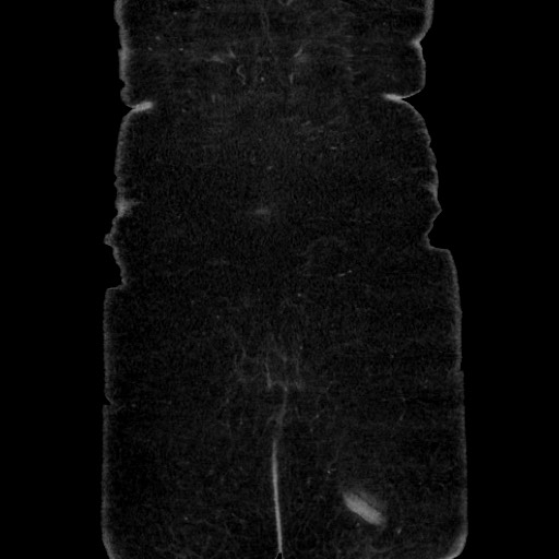 Acute diverticulitis - transverse colon (Radiopaedia 87063-103327 Coronal C+ portal venous phase 154).jpg