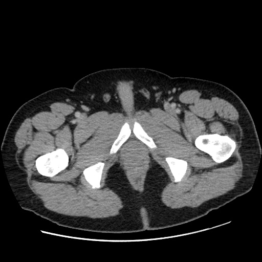 File:Acute diverticulitis with localized perforation (Radiopaedia 41296-44113 Axial C+ portal venous phase 96).jpg