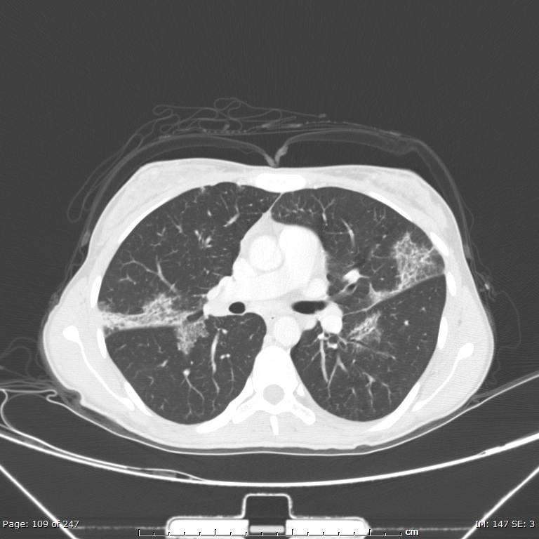 Acute eosinophilic pneumonia (Radiopaedia 48211-53073 Axial lung window 39).jpg