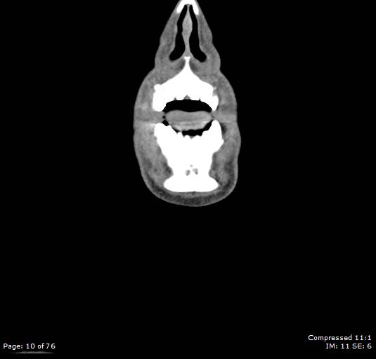 Acute epiglottitis (Radiopaedia 54375-60590 Coronal C+ arterial phase 10).jpg