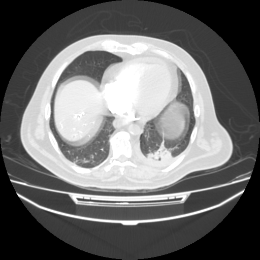 File:Acute heart failure (CT) (Radiopaedia 79835-93075 Axial lung window 35).png