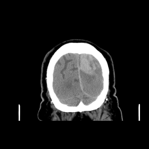 Acute hemorrhagic stroke (Radiopaedia 17507-17223 Coronal non-contrast 52).jpg