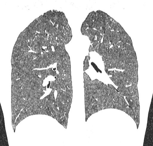 Acute hypersensitivity pneumonitis (Radiopaedia 85293-100870 Coronal lung window 83).jpg