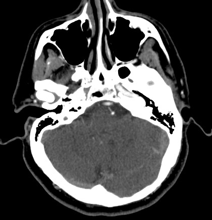 Acute internal carotid artery dissection (Radiopaedia 53541-59630 Axial C+ arterial phase 15).jpg