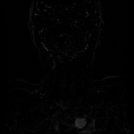 Acute internal carotid artery dissection (Radiopaedia 53541-59632 Coronal MRA 2).jpg
