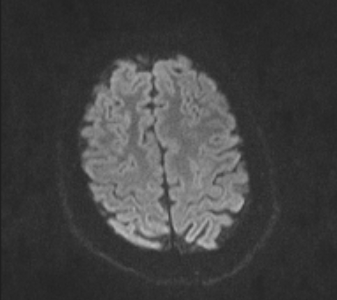 Acute ischemic stroke - posterior circulation territory (Radiopaedia 77670-89880 Axial DWI 65).jpg