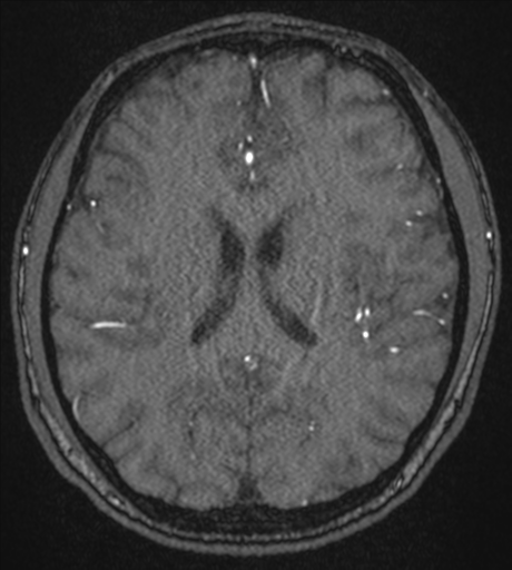 Acute left middle cerebral artery territory infarct with clot retrieval (Radiopaedia 47732-52433 Axial MRA 40).png