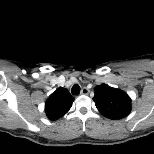 Acute longus colli calcific tendinitis (Radiopaedia 72495-83036 Axial C+ arterial phase 87).jpg