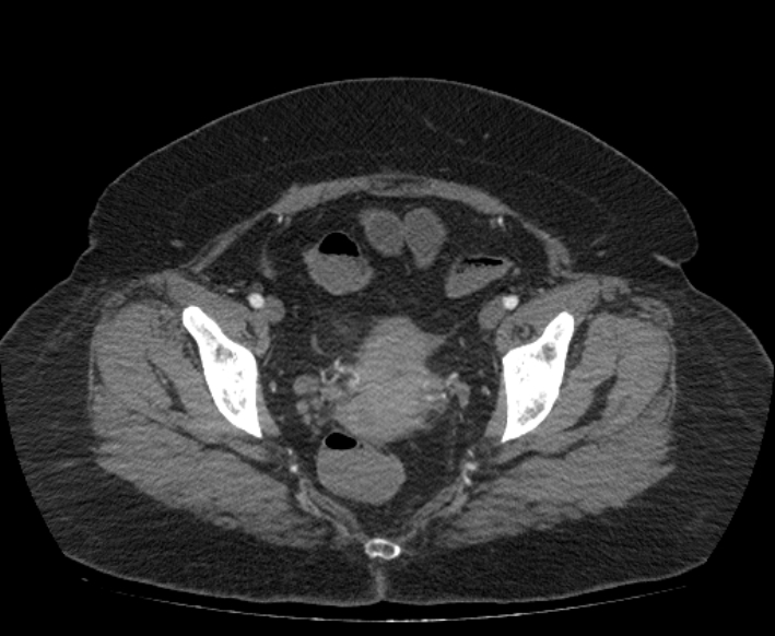 Acute mesenteric ischemia (Radiopaedia 80029-93316 Axial C+ arterial phase 119).jpg