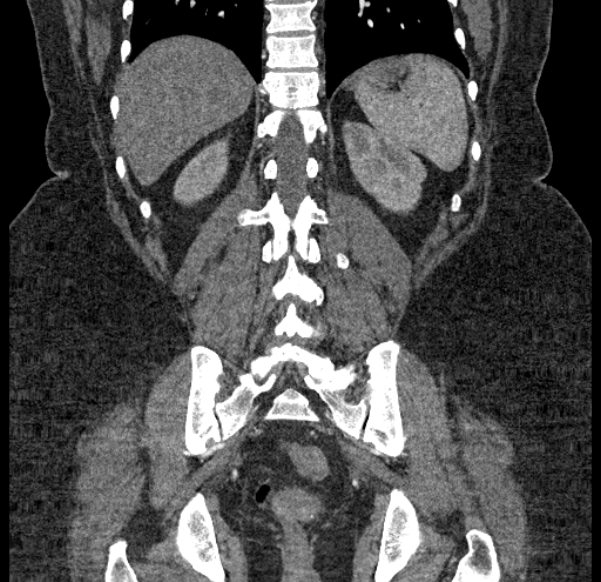 Acute mesenteric ischemia (Radiopaedia 80029-93316 Coronal C+ arterial phase 106).jpg
