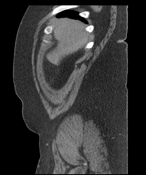 Acute mesenteric venous ischemia (Radiopaedia 46041-50383 Sagittal C+ portal venous phase 11).jpg