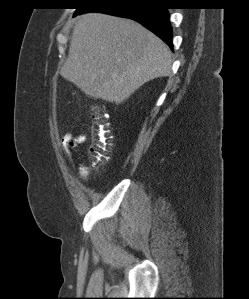 Acute mesenteric venous ischemia (Radiopaedia 46041-50383 Sagittal C+ portal venous phase 20).jpg