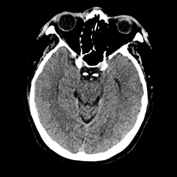 Acute middle cerebral artery territory infarct (Radiopaedia 52380-58283 Axial non-contrast 37).jpg