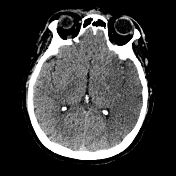 Acute middle cerebral artery territory infarct (Radiopaedia 52380-58283 Axial non-contrast 49).jpg