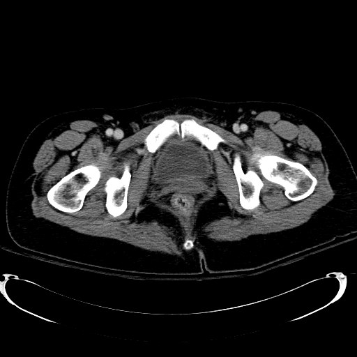 Acute myocardial infarction in CT (Radiopaedia 39947-42415 Axial C+ portal venous phase 135).jpg