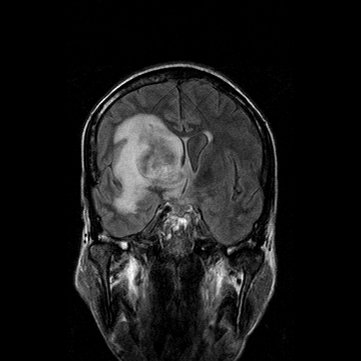 File:Acute necrotizing toxoplasma encephalitis (Radiopaedia 10683-11149 Coronal FLAIR 12).jpg