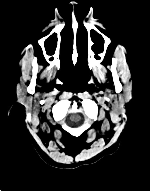 Acute on chronic subdural hematoma (Radiopaedia 74814-85823 Axial non-contrast 23).jpg