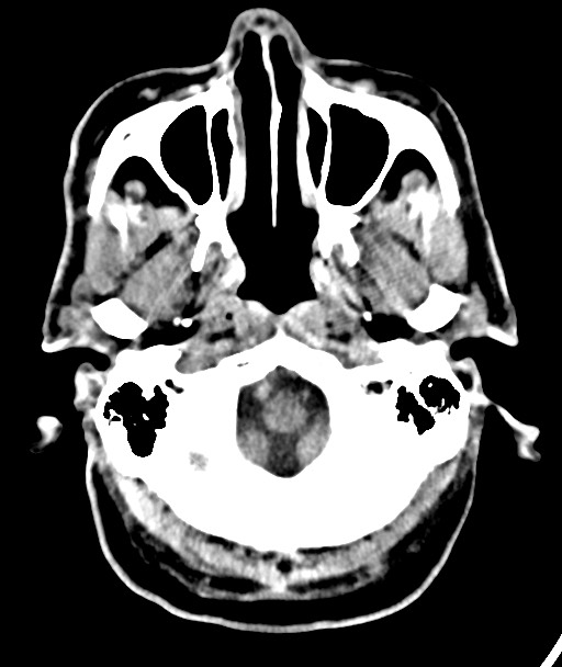 Acute on chronic subdural hematoma (Radiopaedia 78346-90966 Axial non-contrast 14).jpg