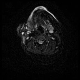Acute otitis externa (Radiopaedia 57296-64236 Axial DWI 49).jpg