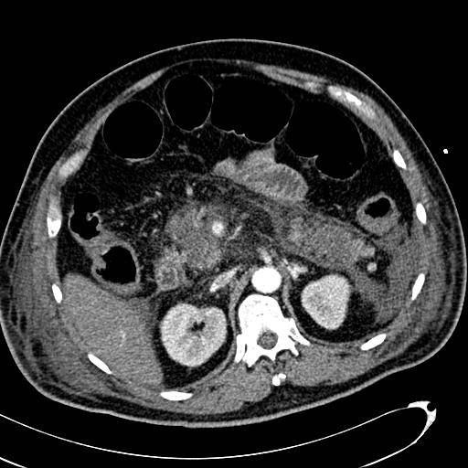 File:Acute pancreatic necrosis (Radiopaedia 13560-13486 Axial C+ portal venous phase 57).jpg