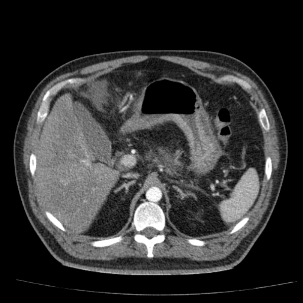 Acute pancreatitis (Radiopaedia 26663-26813 Axial C+ arterial phase 29).jpg
