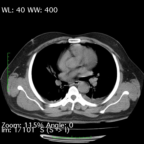 File:Acute pancreatitis (Radiopaedia 34043-35276 Axial non-contrast 1).jpg