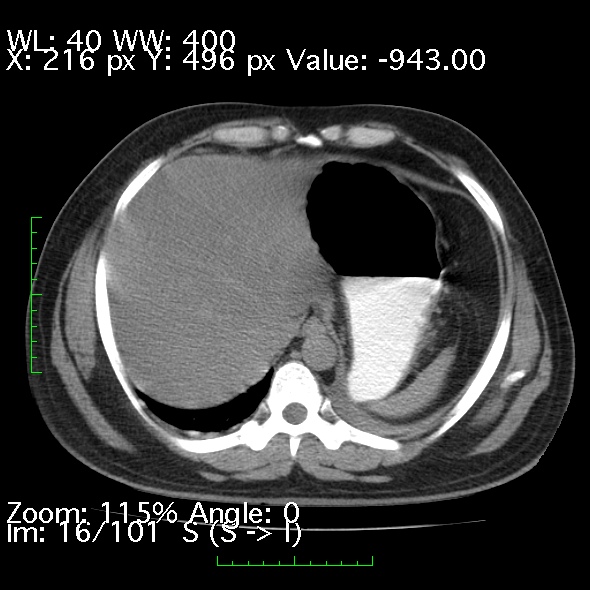Acute pancreatitis (Radiopaedia 34043-35276 Axial non-contrast 16).jpg