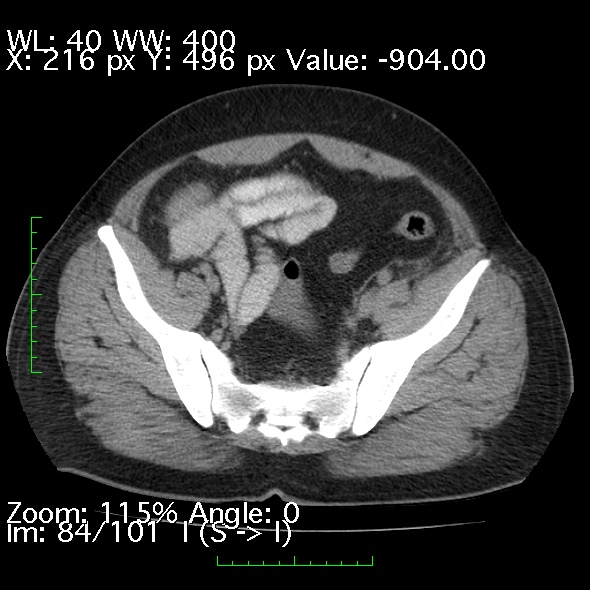 Acute pancreatitis (Radiopaedia 34043-35276 Axial non-contrast 84).jpg