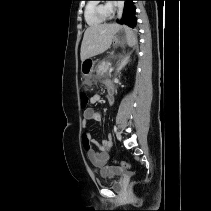 Acute pancreatitis (Radiopaedia 69236-79012 Sagittal C+ portal venous phase 46).jpg