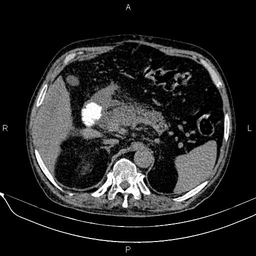 Acute pancreatitis (Radiopaedia 85146-100701 Axial non-contrast 38).jpg