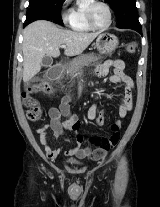 Acute pancreatitis - Balthazar E (Radiopaedia 23080-23110 Coronal C+ portal venous phase 26).jpg