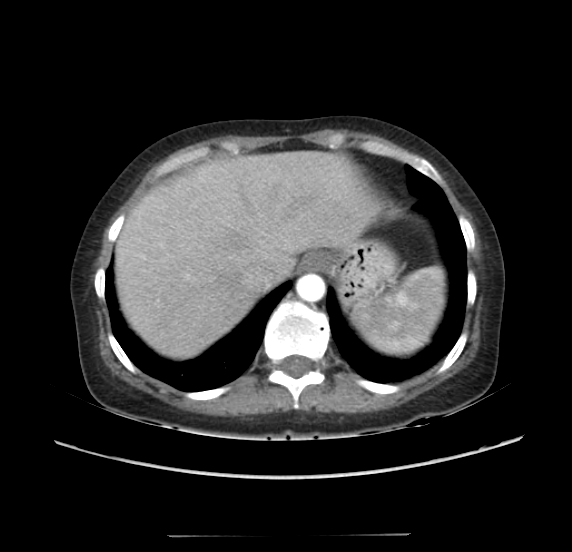 File:Acute pancreatitis - Balthazar E - post ERCP (Radiopaedia 27562-27772 Axial C+ arterial phase 4).png