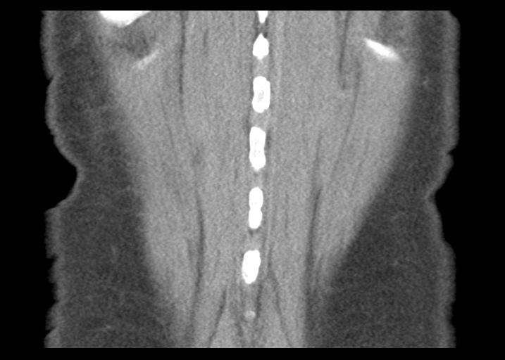 File:Acute pancreatitis and walled-off necrosis (Radiopaedia 29888-30403 Coronal C+ portal venous phase 52).jpg