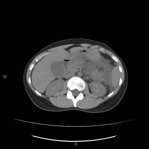 Acute pancreatitis secondary to stone at minor papilla and pancreatic divisum (Radiopaedia 76570-88333 Axial non-contrast 28).jpg